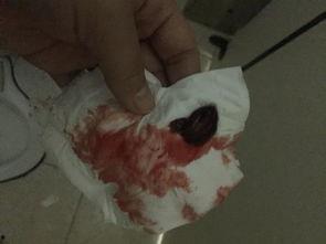 流产血照片,孕期健康警示